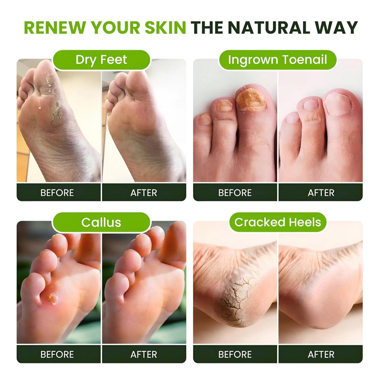 FOOT CURE Tea Tree Oil Foot Soak with Epsom Salt - Best Toenail Fungus Treatment, Athletes Foot & Softens Calluses - Soothes Sore & Tired Feet, Fungal Toe, Foot Odor Scent, Spa Pedicure (Pack of 2)