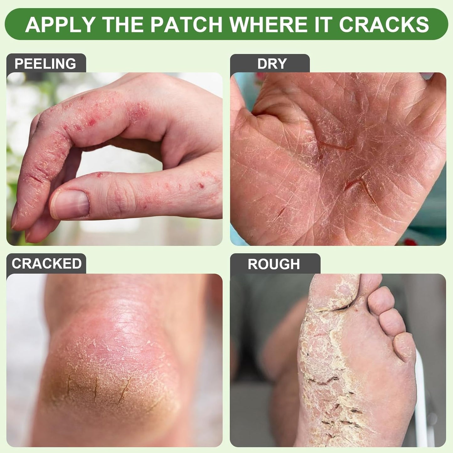 25PCS Aloe Vera Cracked Heel Treatment Patches, Cracked Heel Repair Bandage (Rectangular)