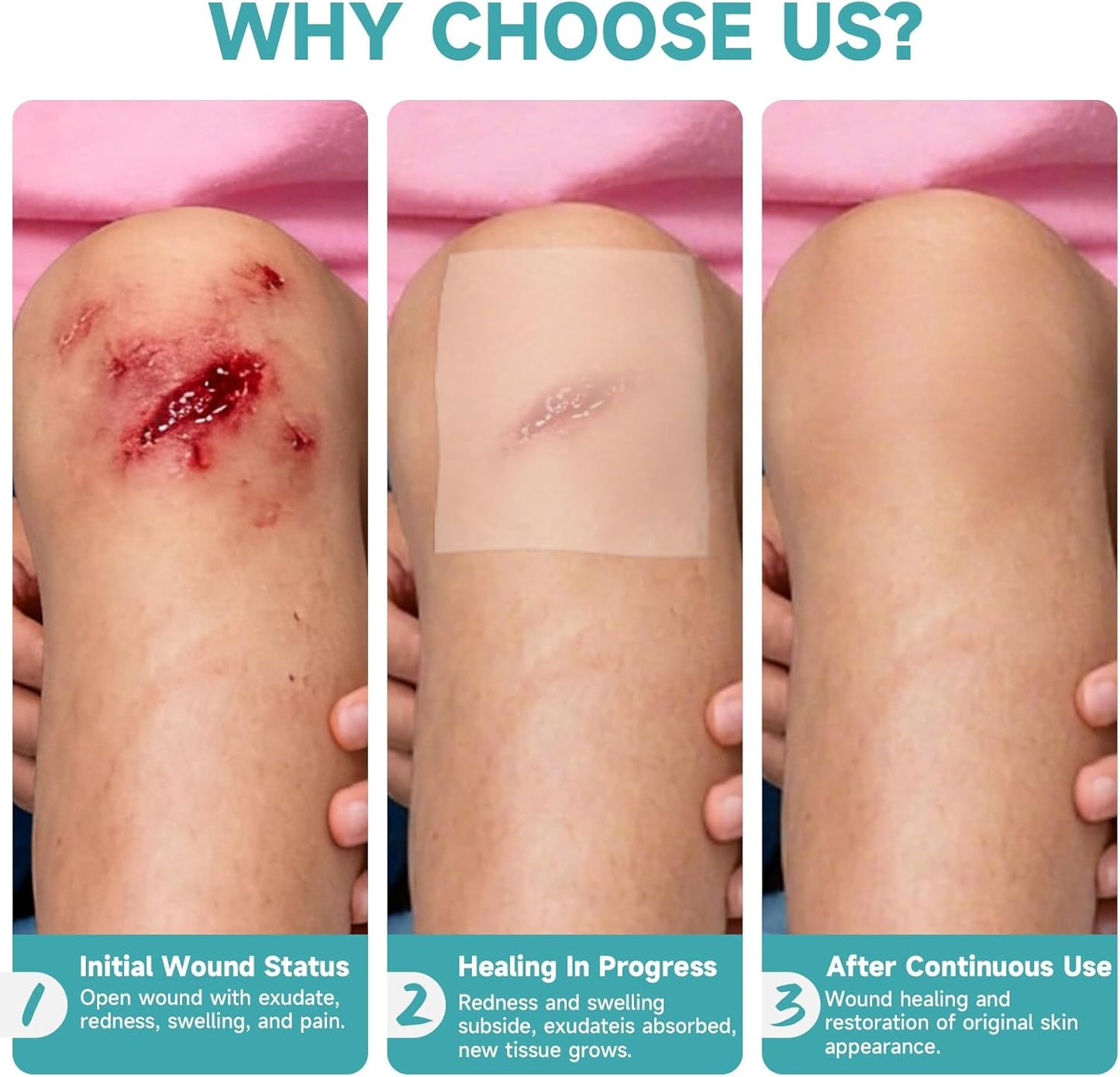 HONKID Hydrocolloid Roll for Wound Care, 2in*16ft Extra Large Cuttable Hydrocolloid Patch Bandages, Self-Adhesive, Super Absorbent, Flexible & Waterproof, Sterile in Aluminum Foil Pouch