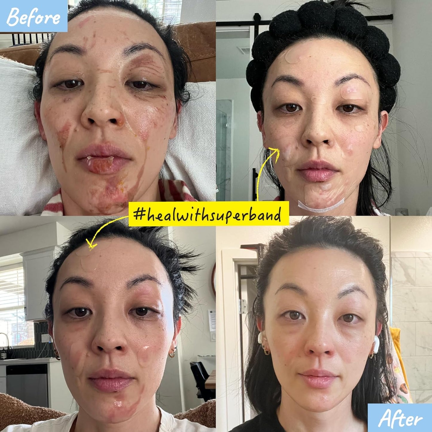 SUPERBAND Premium Hydrocolloid Bandages HSA FSA Eligble Waterproof Wound Dressing by MakeItSkin | Thin, Fast Healing, Scar Reducing for Scratches, Cuts, Burns, Blisters, Fissures, Road Rashes