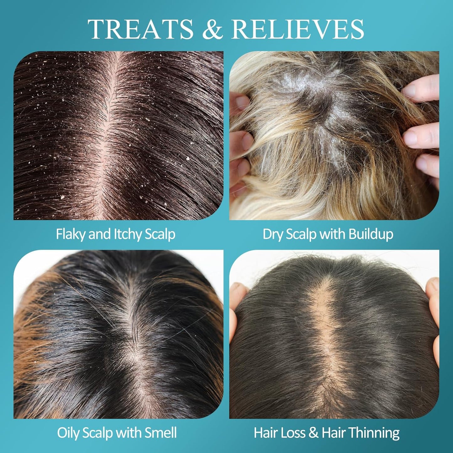 Scalp Scrub, Biotin 2-in-1 Scalp Exfoliator Scrub Clarifying Detox Shampoo with 3% Salicylic Acid & Tea Tree for Dandruff, Build Up, Itchy Scalp, Oily Hair & Dry Scalp Treatment with Scalp Massager