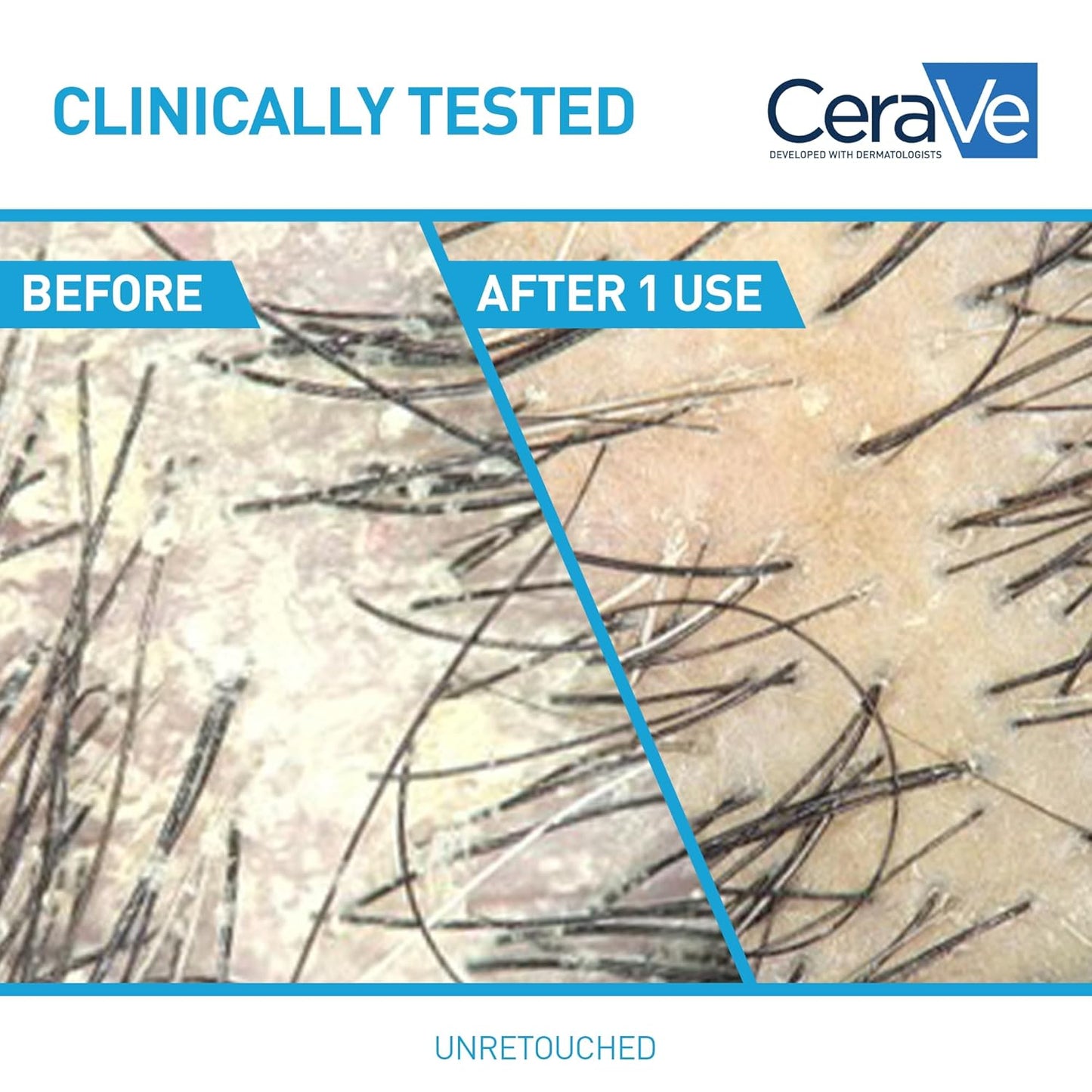 CeraVe Hydrating Anti Dandruff Shampoo, 1% Pyrithione Zinc Dandruff Treatment With Ceramides, Niacinamide & Hyaluronic Acid, Helps Eliminate Flakes & Provides Itchy Scalp Relief, Sulfate Free, 12 Oz
