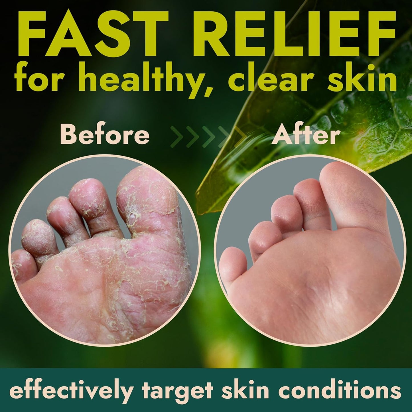 Foot Cream with Tea Tree Oil | Antifungal Cream to Soothes Cracked Heels, Dry Skin & Itchy Feet | Helps with Athleteβs Foot, Nail Fungus & Jock Itch | Relieves Itching & Burning | 4.05 fl oz