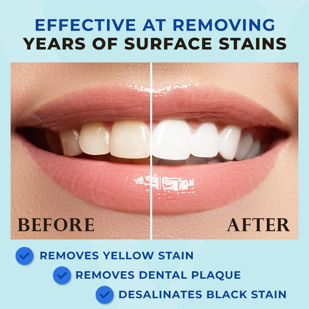 Venus Visage Award Winning Teeth Whitening Pen, 20+ Uses - Teeth whitening Kit Professionally formulated - Best Teeth whitening Gel Pen Teeth Whitener - Low Sensitivity (Mint) (0.07 Fl Oz (Pack of 2))