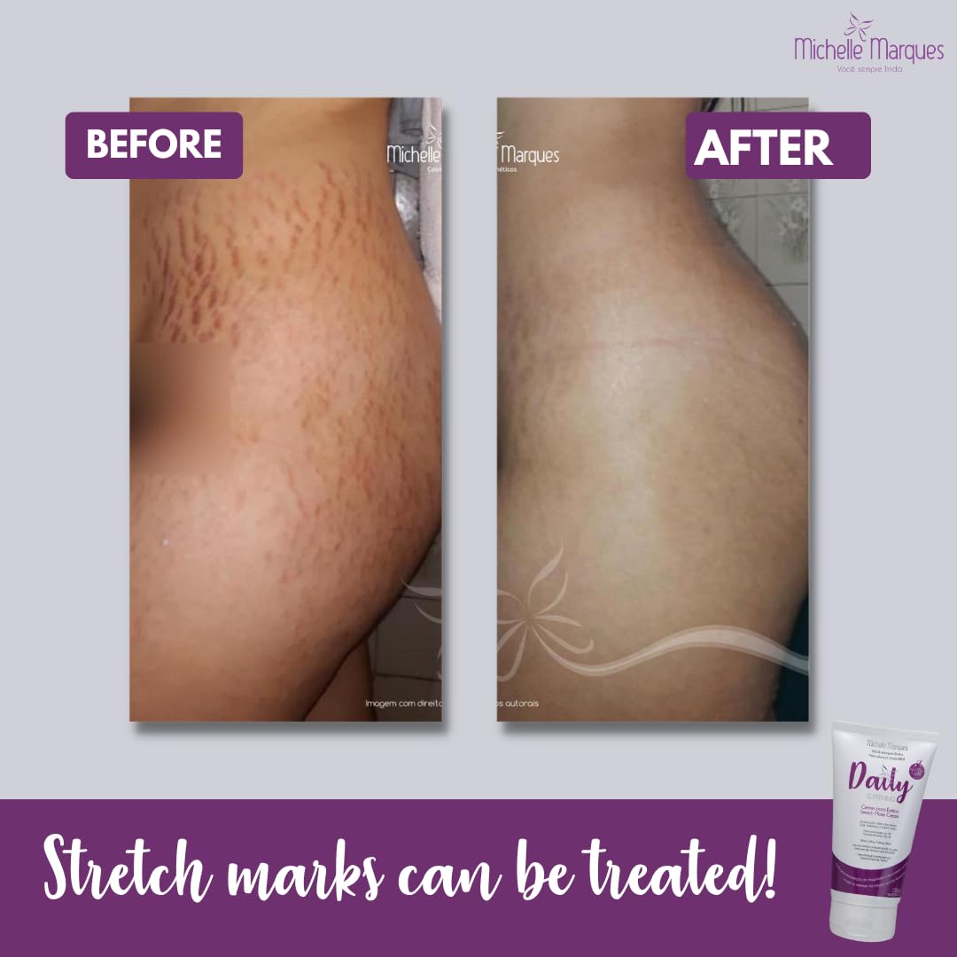 Stretch Mark Cream, Soften and Reduce the Appearance, Provides Hydration, and Improves Skin Elasticity and Texture, 5.29oz