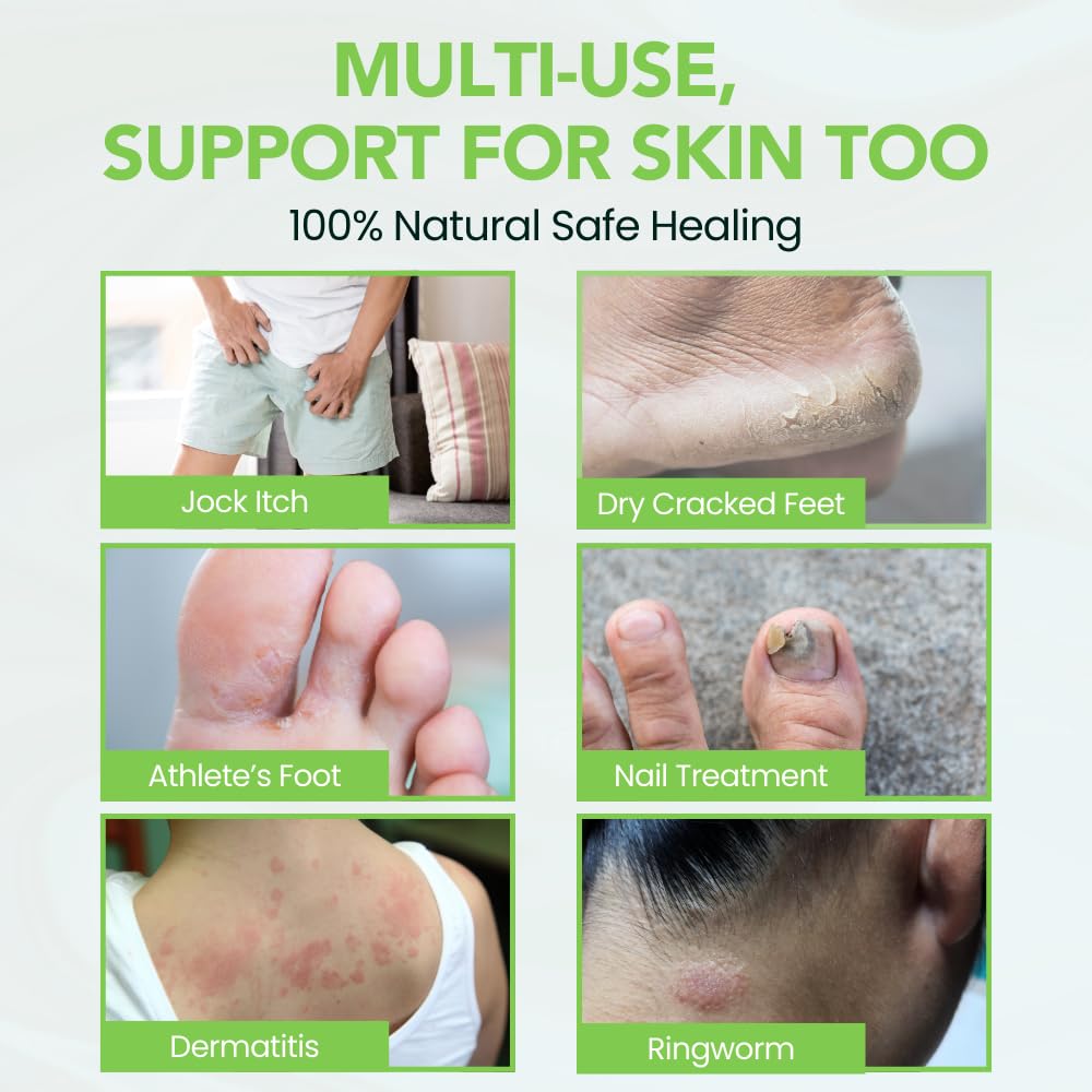 THENA Athlete’s Foot Treatment Balm Extra Strength with Tea Tree Peppermint Neem, Powerful Natural Anti-Itch Foot & Skin Cream Soothes & Relieves Itchy, Dry, Cracked Feet, Heels, Toenails, Jock Itch