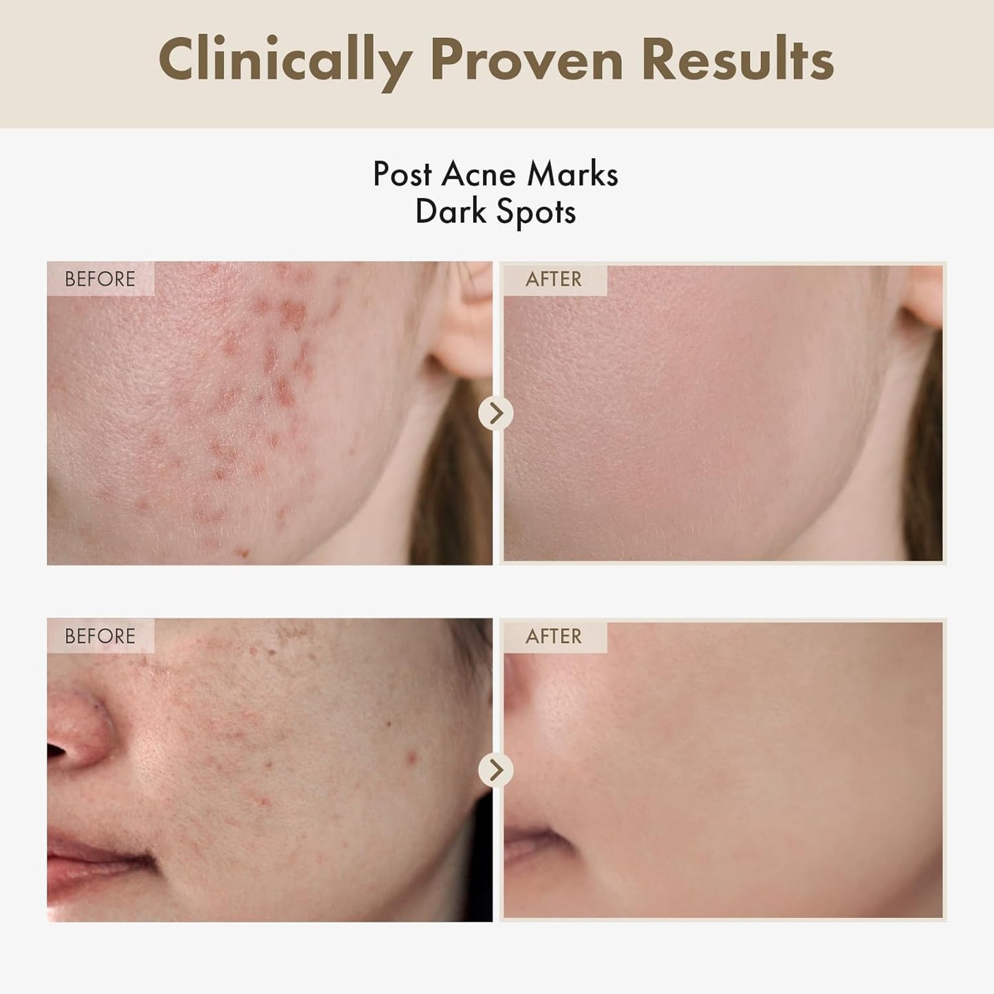 TOSOWOONG Alpha Arbutin 2% Rice Serum, Rice 746,074ppm, Alpha-Arbutin 20,000ppm, Glow, Glass skin, Pigmentation, Acne Marks, Dark Spots, Even Skin Tone, Hydrating, Korean Skin Care, 33ml / 1.11 fl.oz.