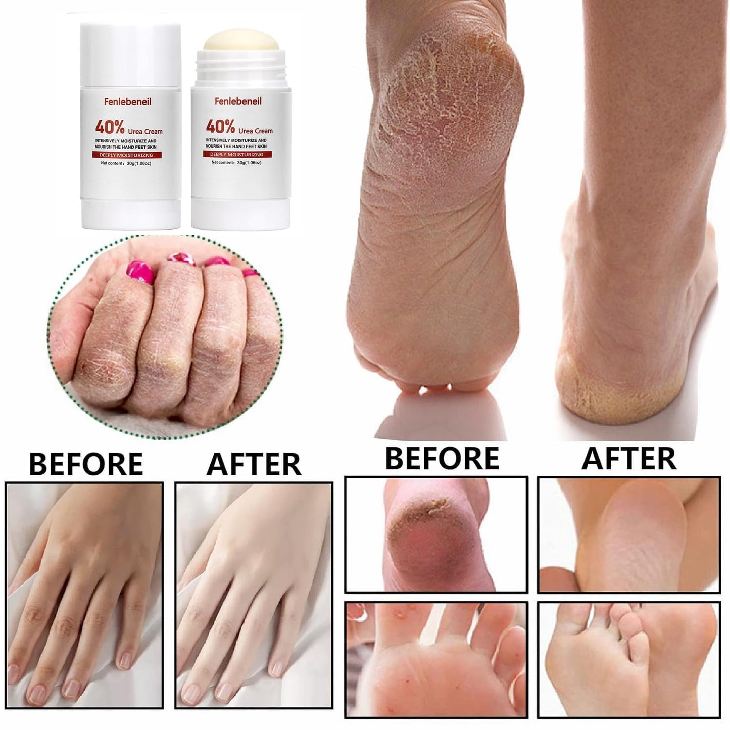 40% Urea Cream Cracked Heel Balm for Dry, Cracked Feet, Heals, Foot Hand Moisturizing 40 Percent Foot Urea Cream for Feet Maximum Strength 2Pack