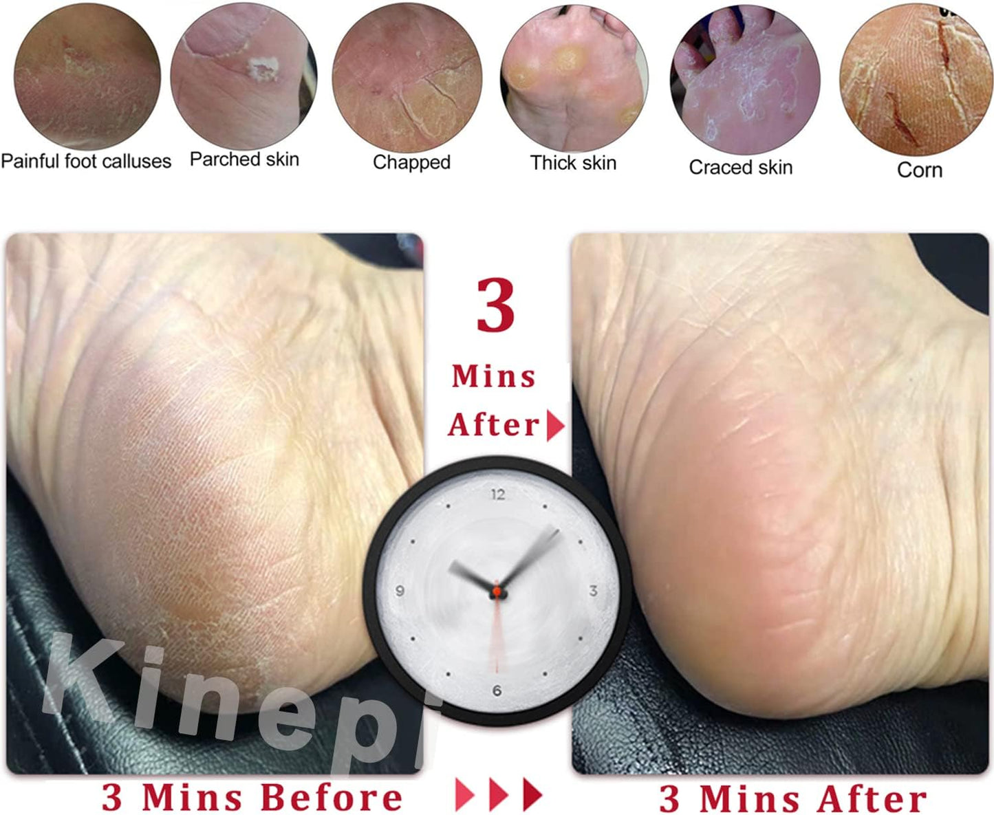 Feet Callus Removers Professional Colossal Foot Scrubber Pedicure Foot File Foot Massager Pumice Stone for Feet,Remover Corn Hard Skin Dead Skin Exfoliator for Use in Shower Feet Care Tools