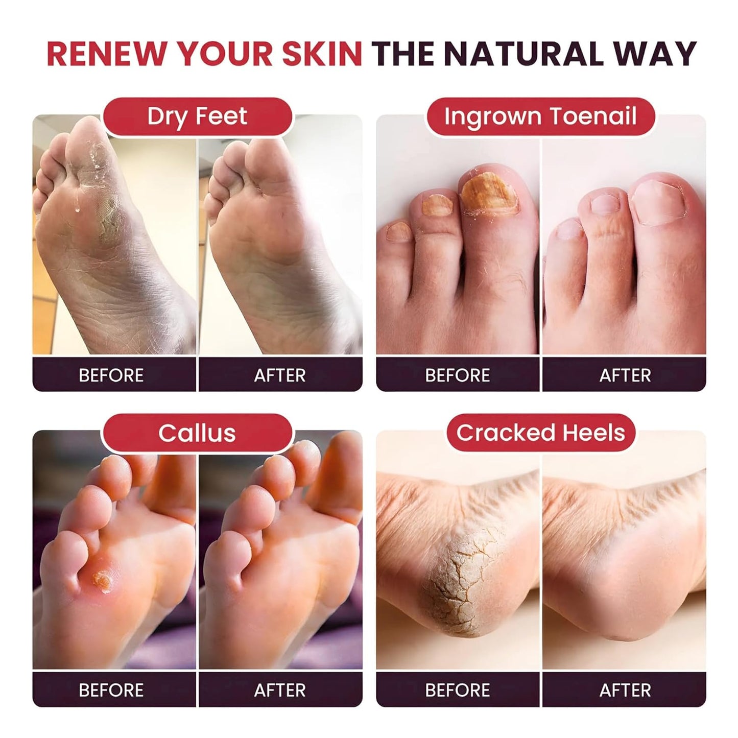 FOOT CURE Tea Tree Oil & Muscle Foot Soak with Epsom Salts - All-Natural Salts for Post-Workout Recovery - Softens Calluses, Soothes Sore & Tired Feet, Foot Odor Control, Spa Pedicure (Pack of 2)