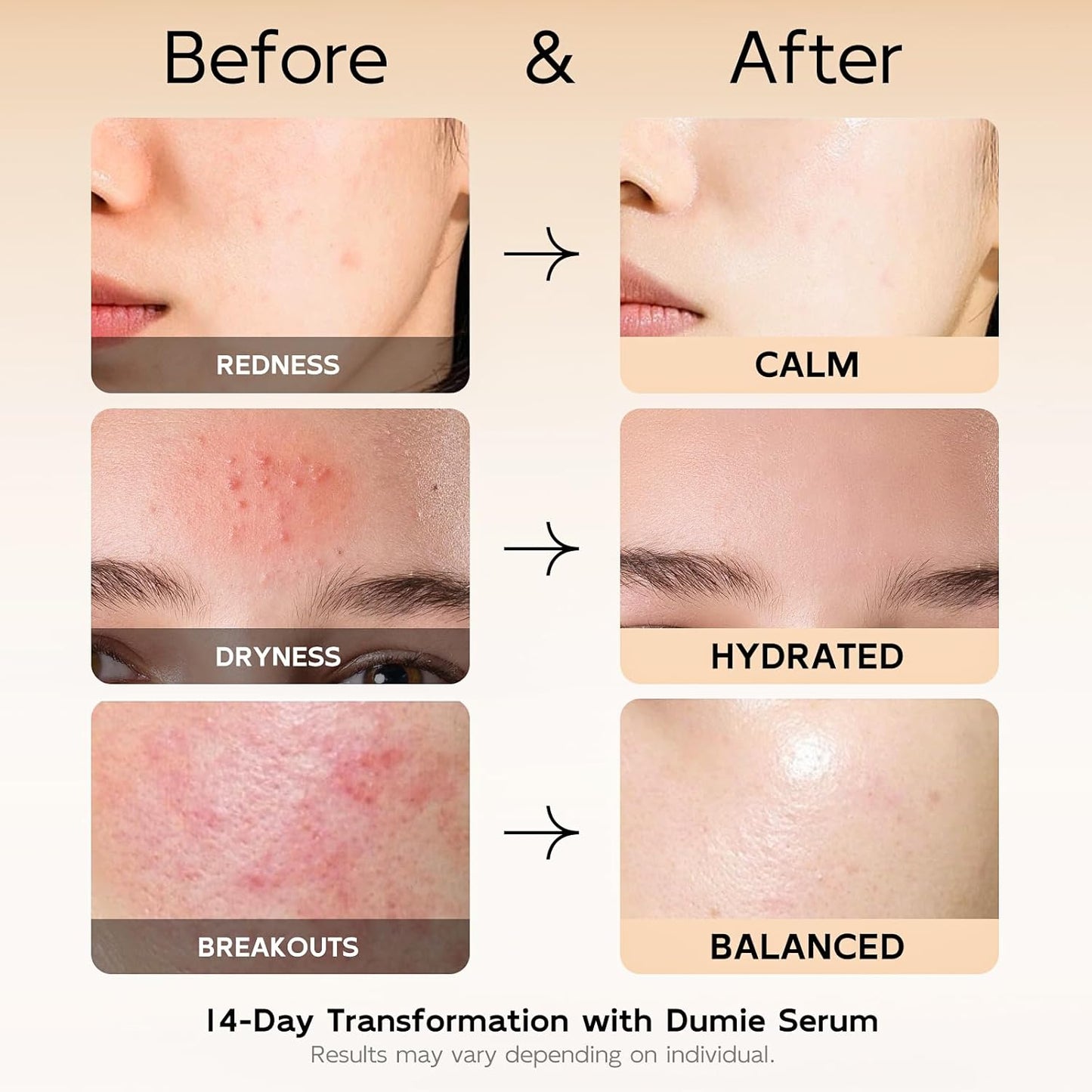 Azelaic Acid Serum 10%, Azelaic Acid for Face with Centella Asiatica Serum for Redness and Uneven Skin Tone, Hyaluronic Acid & Ceramide 3 – Soothes & Clears Pores for Sensitive Skin, 1.01 fl oz