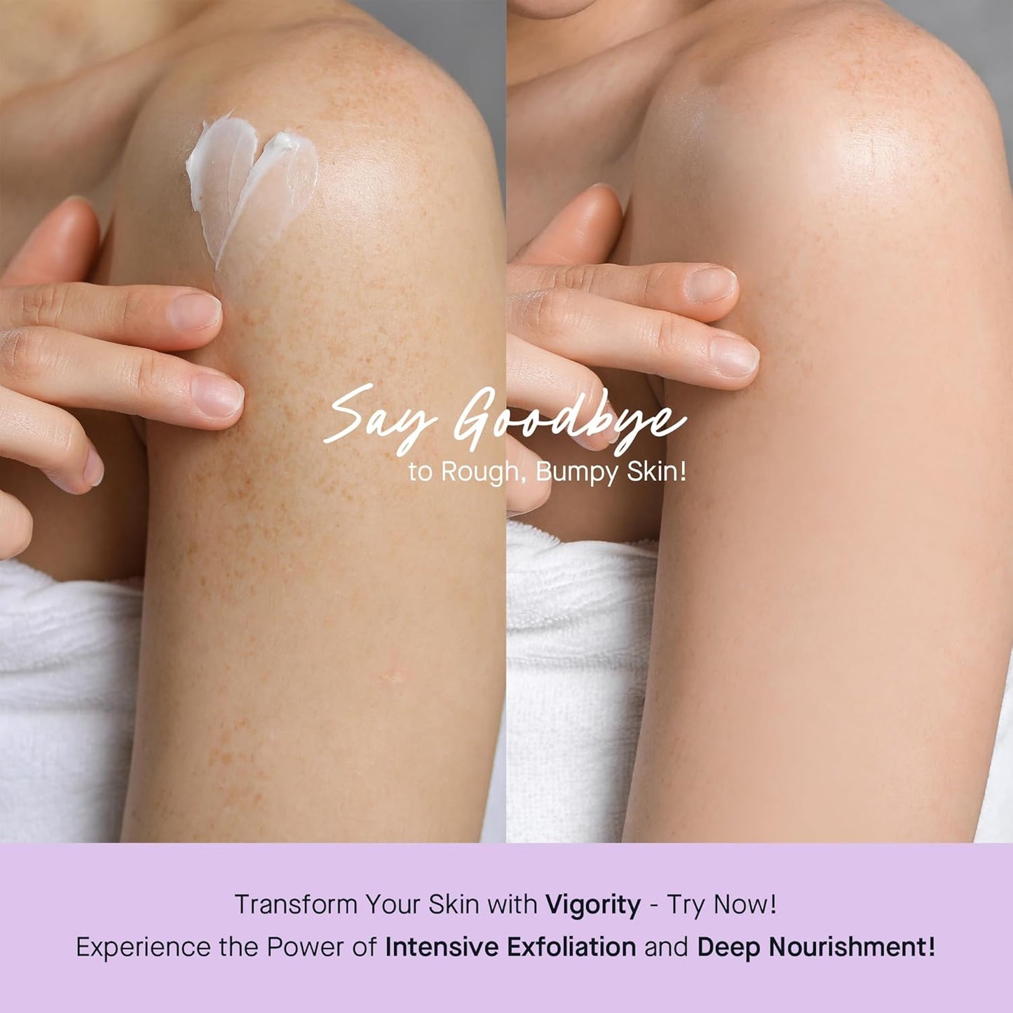 Vigority Keratosis Pilaris Treatment Cream with Lactic Acid – KP Body Bump Exfoliating Moisturizer for Rough, Bumpy, Dry & Flakey Skin, Strawberry Legs – 5.1 Oz