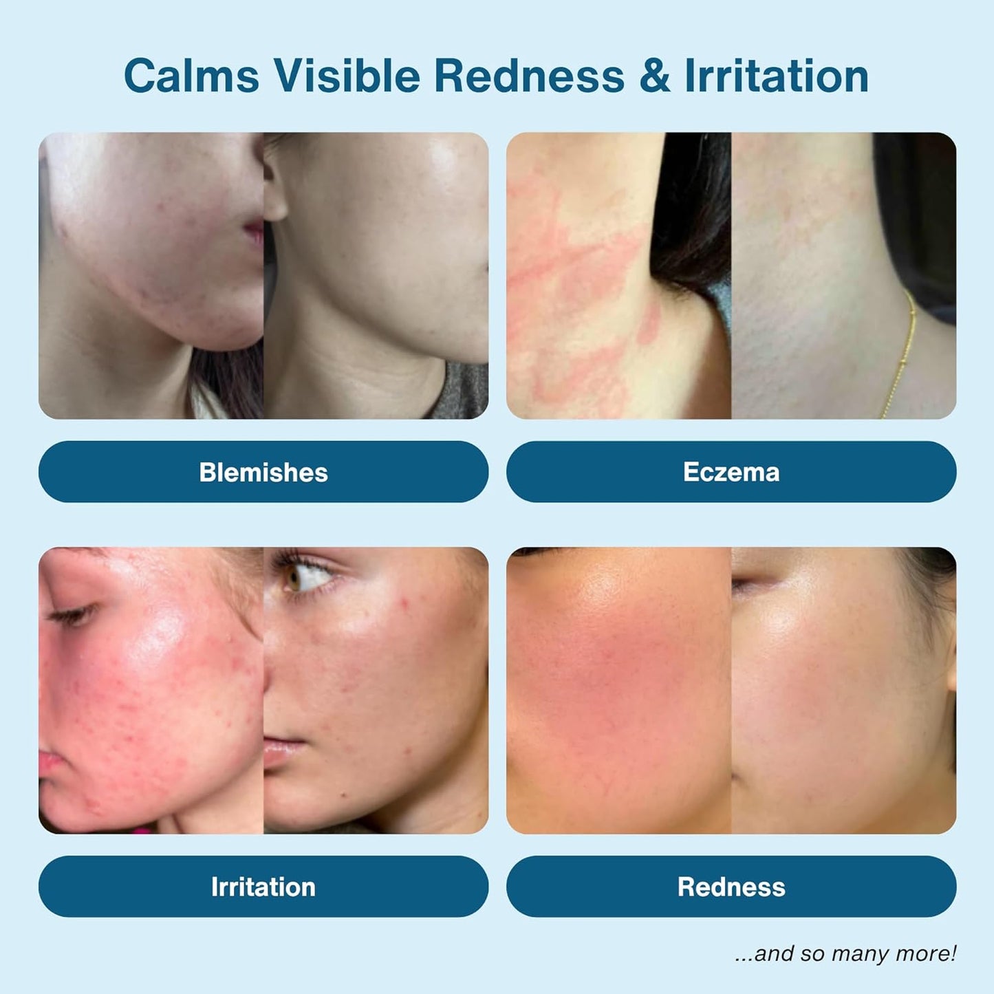 Honeydew Labs Hypochlorous Acid Spray – HOCl Face & Skin Mist for Acne, Eczema & Irritation – Multi-Purpose Skin Repair – Eyelid Cleanser, Post-Workout, Post-Procedure, Scalp, Sensitive Skin TSA 2 oz