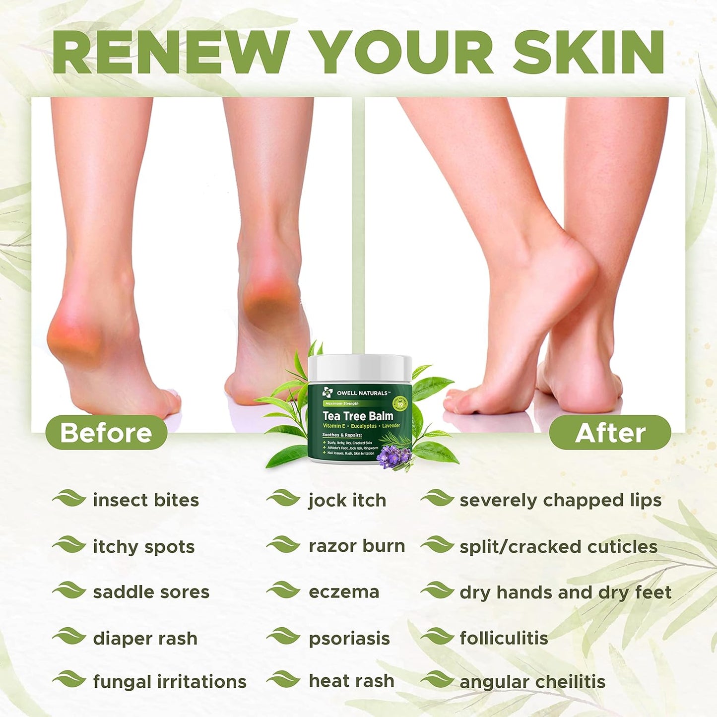 OWELL NATURALS Tea Tree Balm Oil with Vitamin E for Itchy, Dry, Flaky and Cracked Skin, Athletes Foot, Hands, Rashes, Bee Stings, Splinters, Poison Ivy, Insect Bites, Cuts and Burns, (1 Pack)