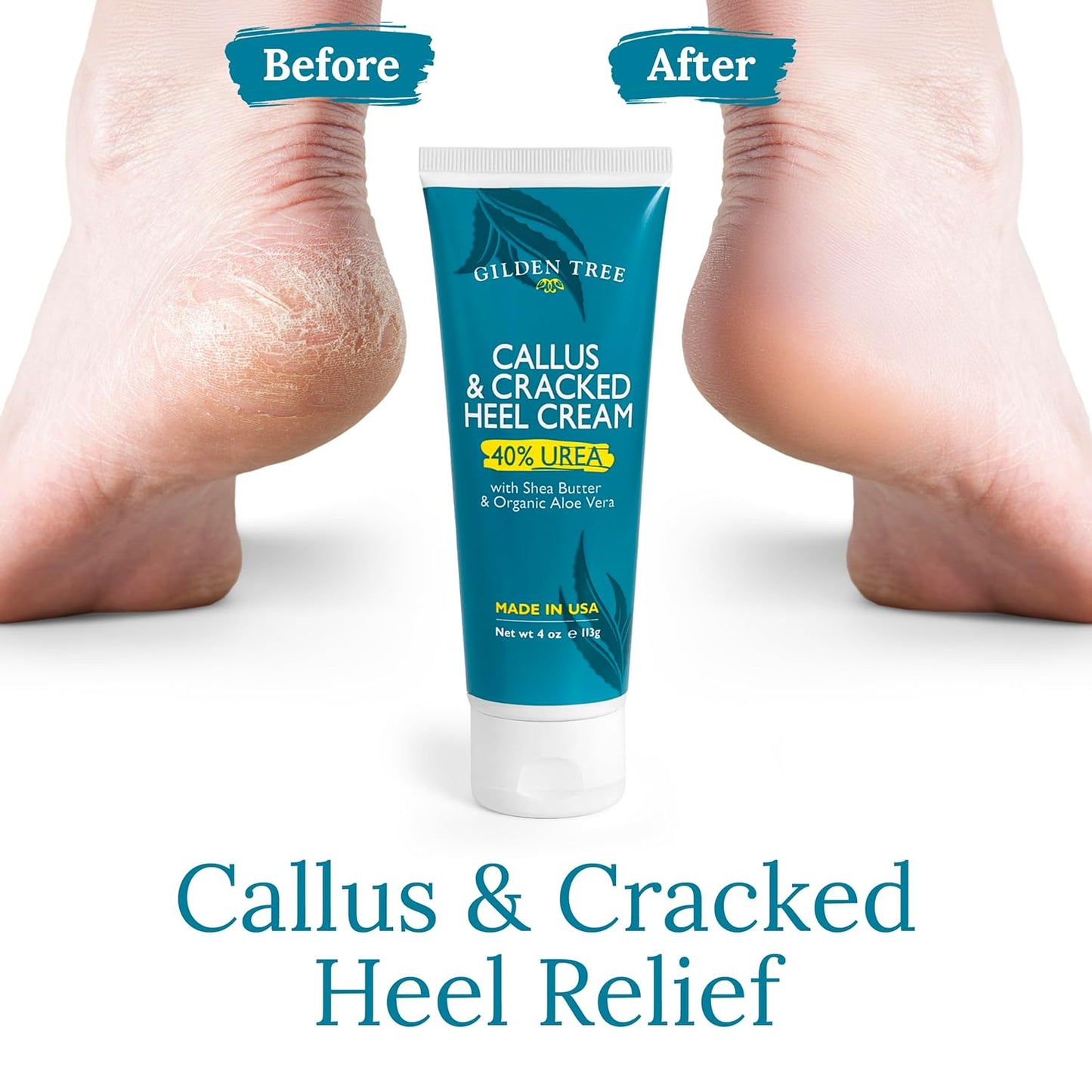 GILDEN TREE Urea Cream 40 Percent for Feet Maximum Strength Cracked Heel Treatment Foot Cream for Calluses and Dry Feet, Enriched with Shea Butter & Aloe for Moisturizing, Made in USA