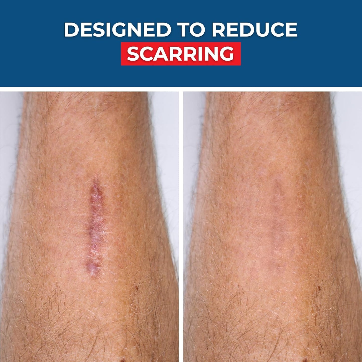 SilverSeal Hydrogel Burn & Wound Dressing Kit with X-Static Silver - FDA Cleared Care for Burns, Cuts & Wounds – Soothing Moisture, Relief & Protection - 4 (2”x3”) Hydrogels + 4 (3”x5”) Adhesive Pads