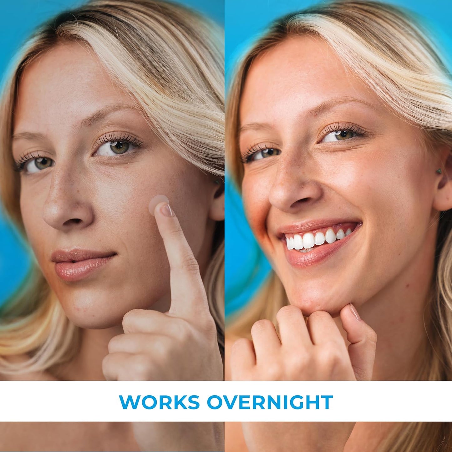 Pimple Patches for Face (500 Patches), Hydrocolloid Acne Patches with Tea Tree Oil, Pimple Patch Pimple Stickers - Hydrocolloid Patch Acne Dots - Acne Pimple Patches For Face - Zit Patches