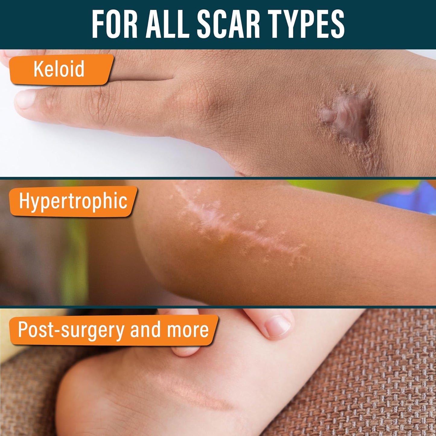 NUVADERMIS Silicone Scar Tape for Kids - Scar Tape for Surgical Scars - 120" x 1.5" Roll - Reusable Medical Grade Silicone Scar Tape for Children - 1 Pack - Dinosaurs