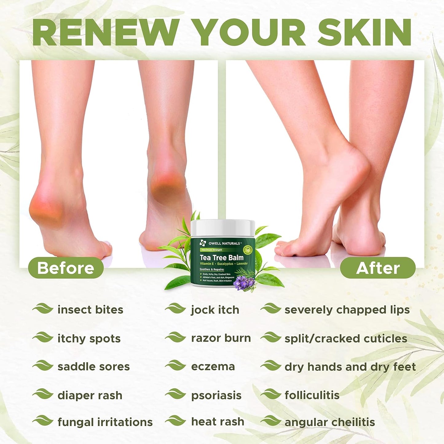 OWELL NATURALS Tea Tree Balm Oil with Vitamin E for Itchy, Dry, Flaky and Cracked Skin, Athletes Foot, Hands, Rashes, Bee Stings, Splinters, Poison Ivy, Insect Bites, Cuts and Burns, (2 Pack)